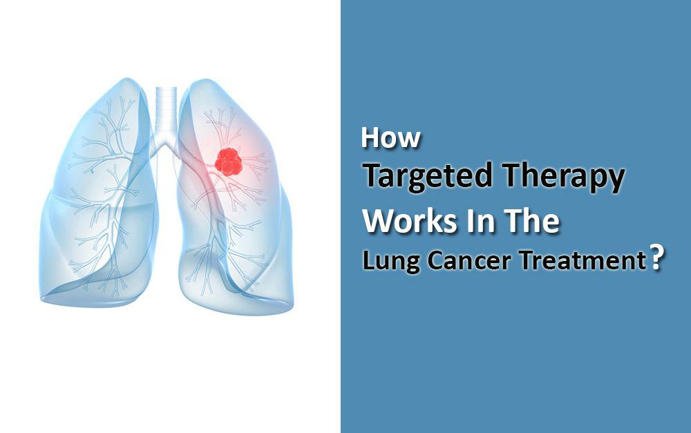 How Targeted Therapy Works In The Lung Cancer Treatment? - HBG Medical ...