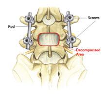 Decompression Spine Surgery Treatment| Hospital & Doctors | HBG