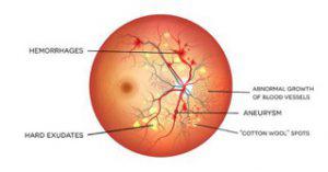 Diabetic Retinopathy Hospital & Doctors in India - HBG Medical Assistance