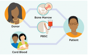 Best Allogenic Bone Marrow Transplant Treatments Hospital & Doctors In ...