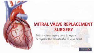 Best Mitral Valve Replacement Surgery Treatments Hospital & Doctors In ...