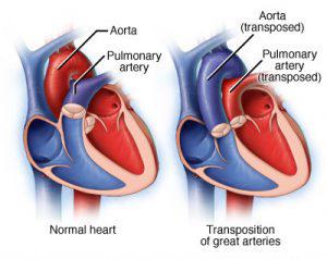 Best Truncus Repair surgery Treatments Hospital & Doctors in India ...