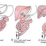 Best Intestinal Transplantation Treatments Hospital & Doctors in India ...