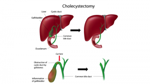 Best Cholecystectomy Treatments Hospital & Doctors in India | HBG ...