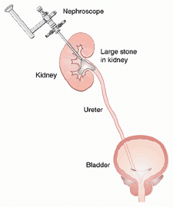 Best Percutaneous Nephrolithotomy (PCNL) Treatments Hospital & Doctors ...